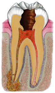 根管治療・歯内療法（エンド）が必要な歯