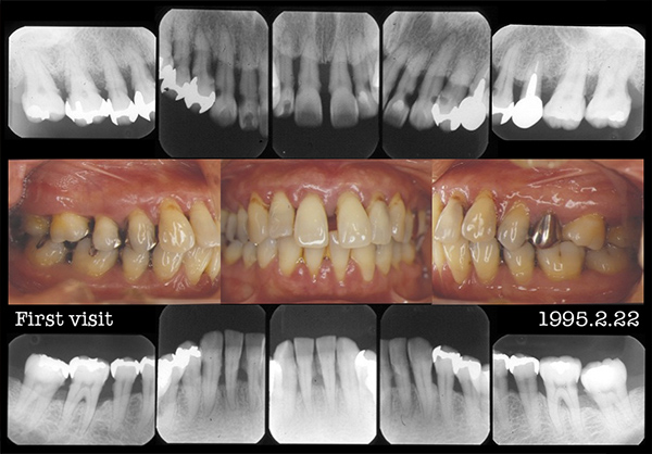歯周病長期症例その1　45歳　女性