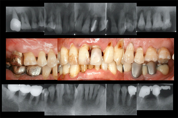 歯周病長期症例その2　53歳　男性