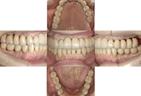 インプラント治療　症例①
                                