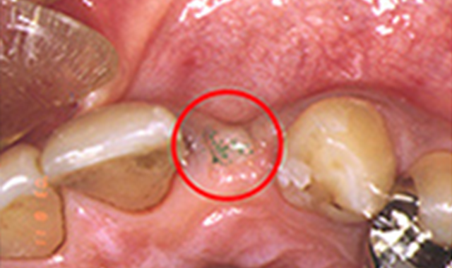インプラント治療　症例②
                                