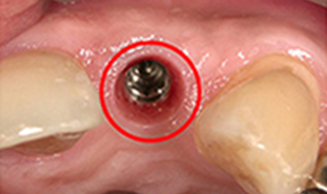 インプラント治療　症例②
                                