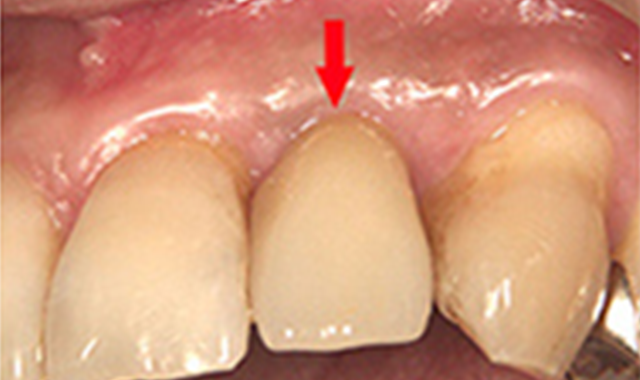 インプラント治療　症例②
                                