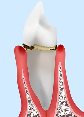 初期歯周病