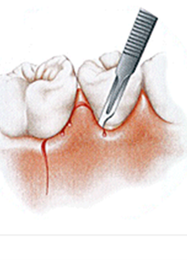 歯肉の切開