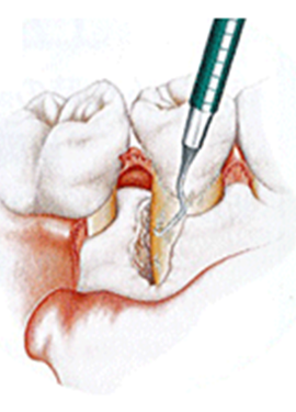 歯根表面の清掃