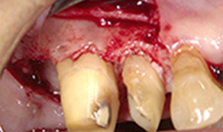 歯肉フラップを開け、SRPと骨形成を行います。
